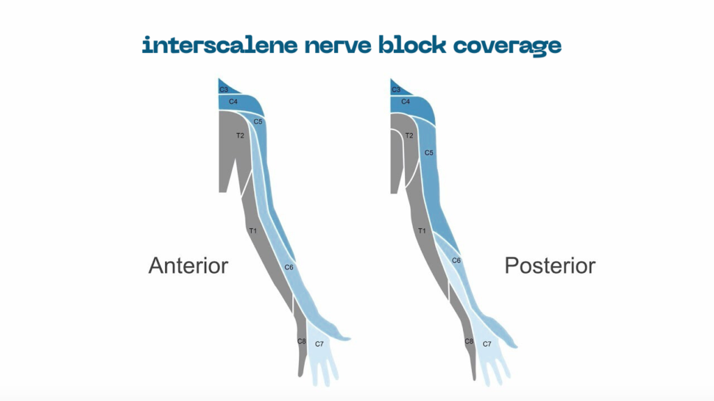Interscalene Nerve Block Coverage A Complete and Practical Guide